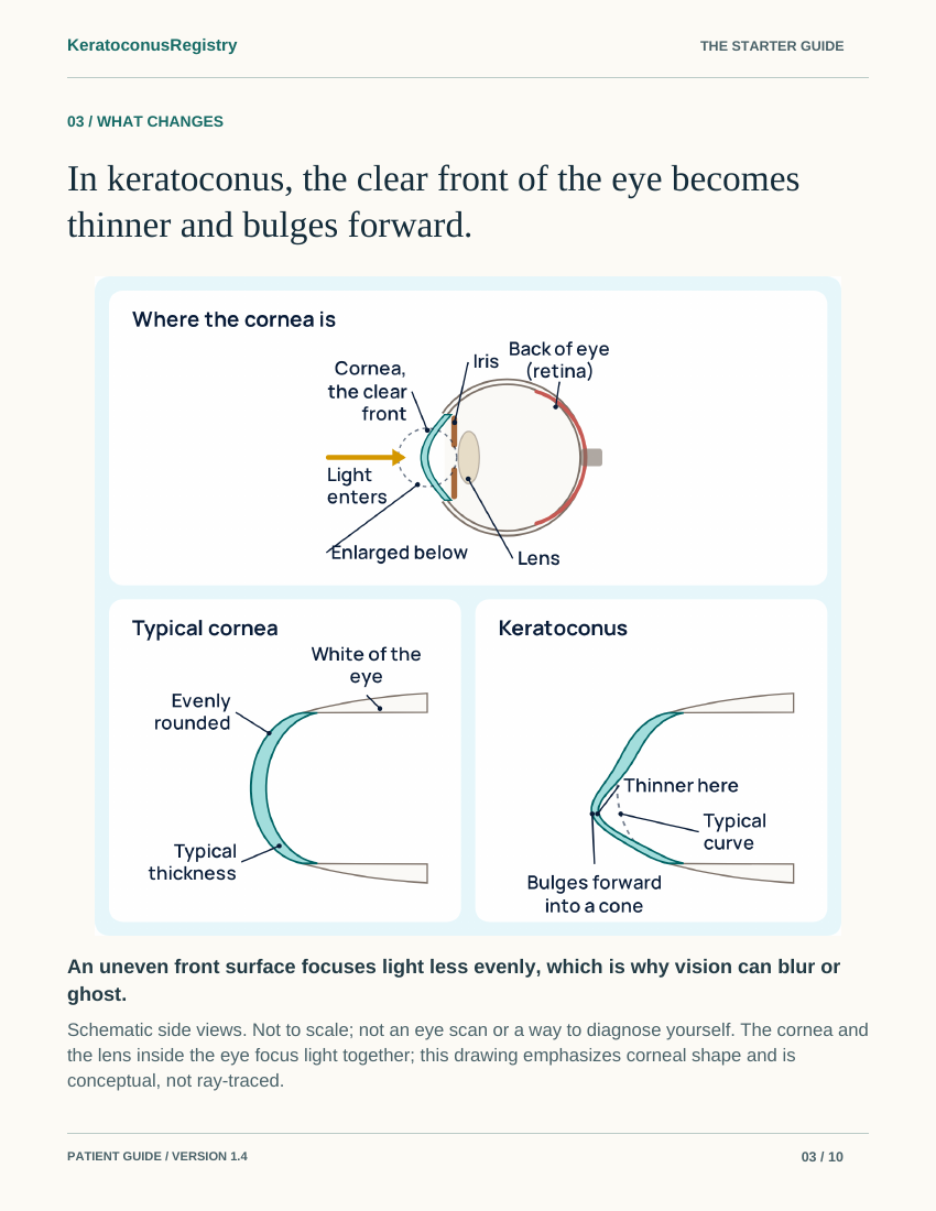 Page 3 of the guide: a full-page labeled drawing showing where the cornea is, and a typical cornea beside one with keratoconus.